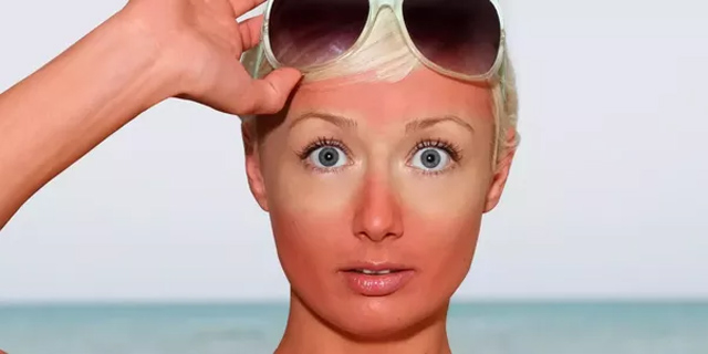 women with sunglasses showing her sunburn